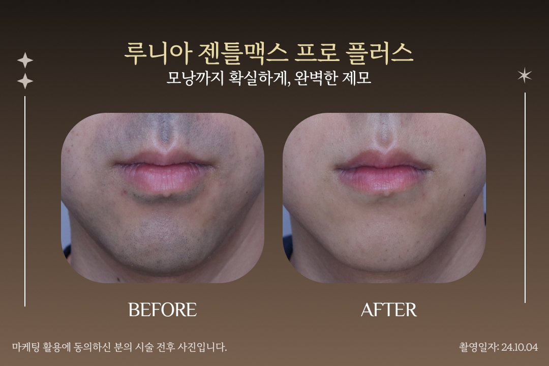 젠틀맥스 프로 플러스 제모