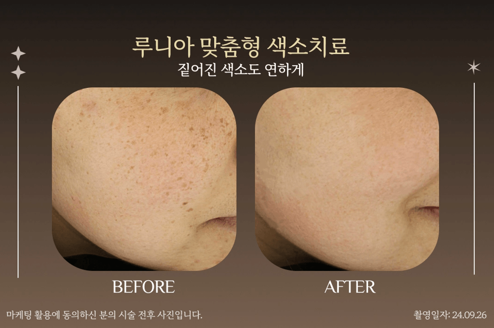 1:1 맞춤형 색소 프로그램