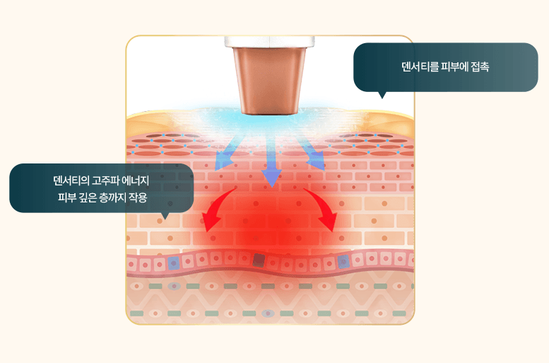 최대 출력 400W 모노폴라 & 바이폴라
고주파 에너지를 한 샷에 교차 조사